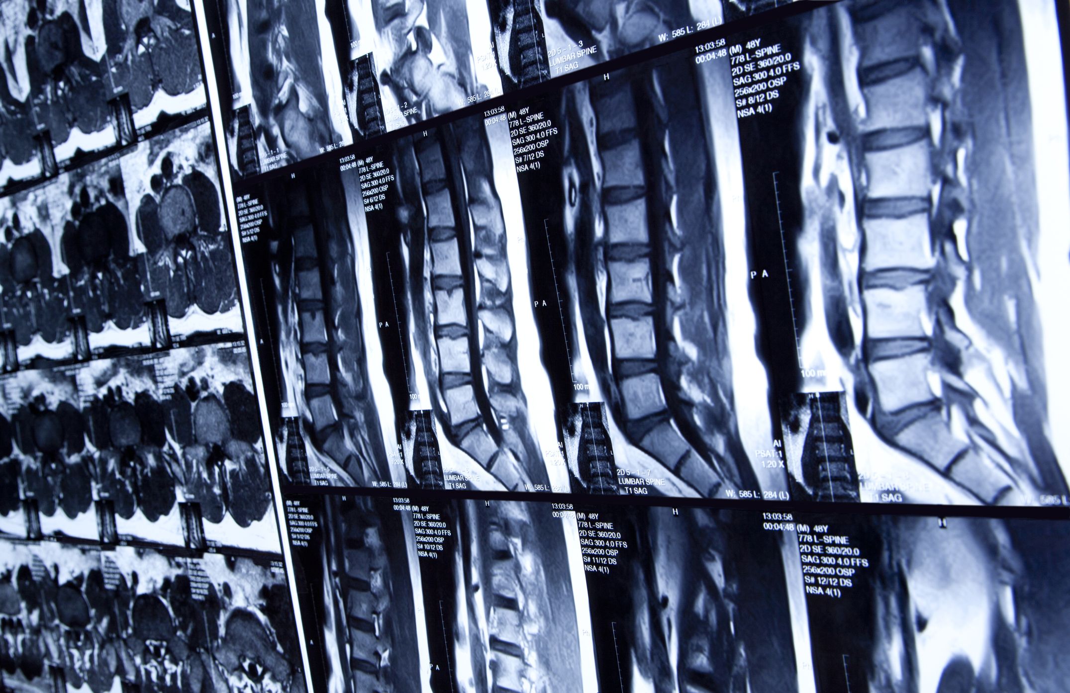 spinal cord x ray